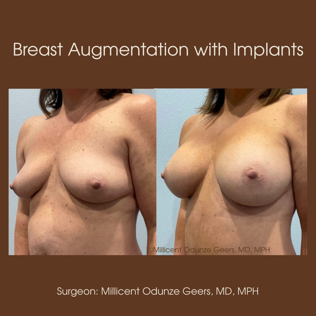 Best Breast Augmentation Colorado Springs