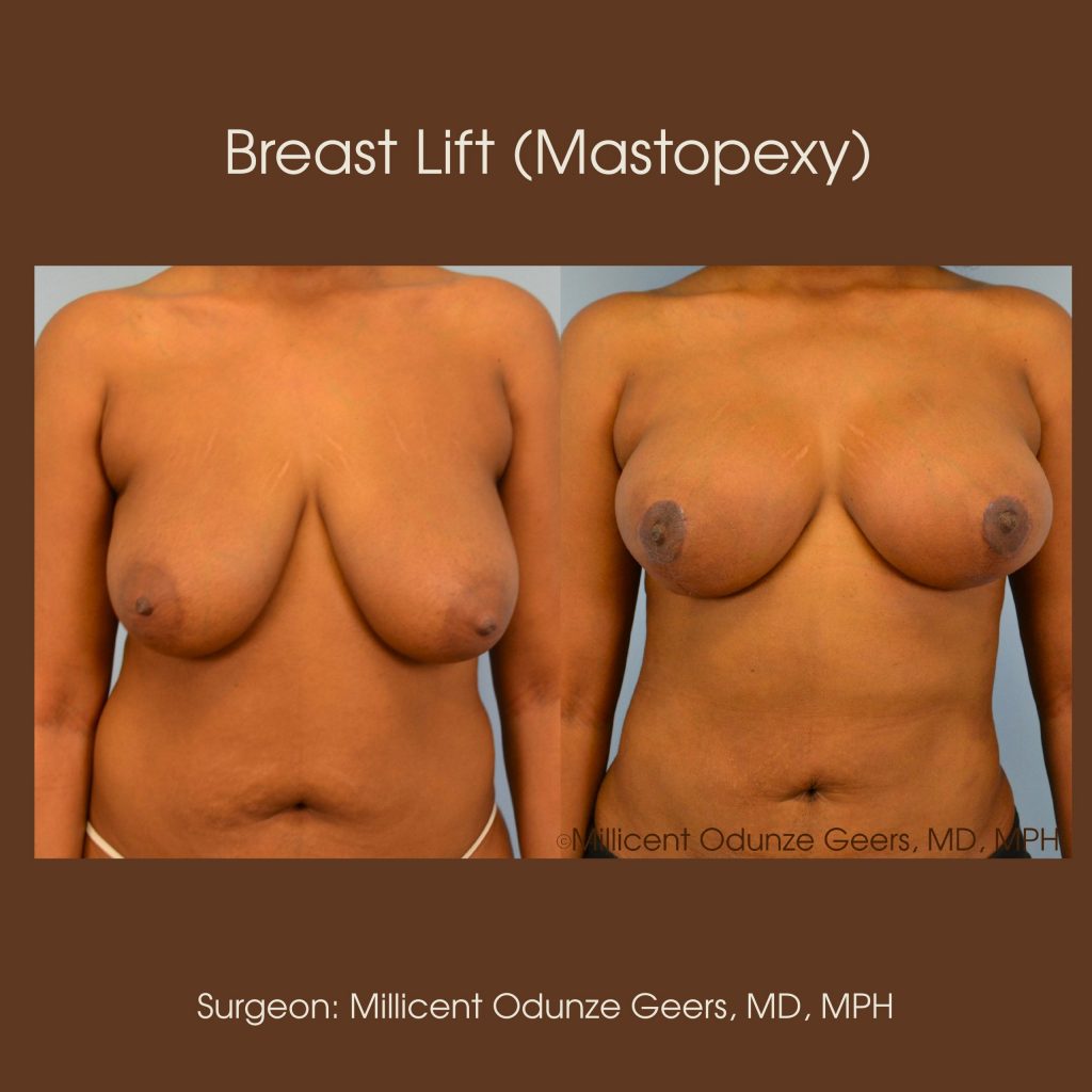 Best Breast Lift Colorado Springs