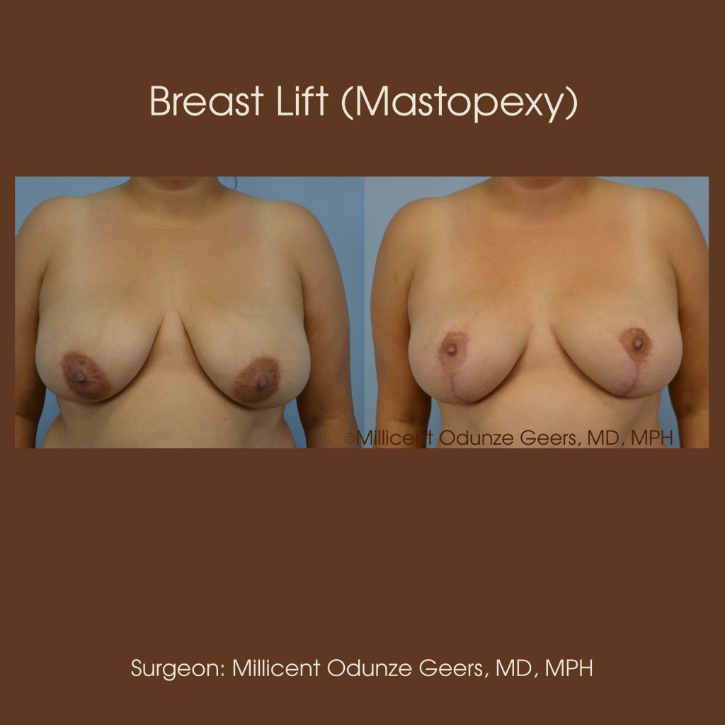 Best Breast Lift Colorado Springs