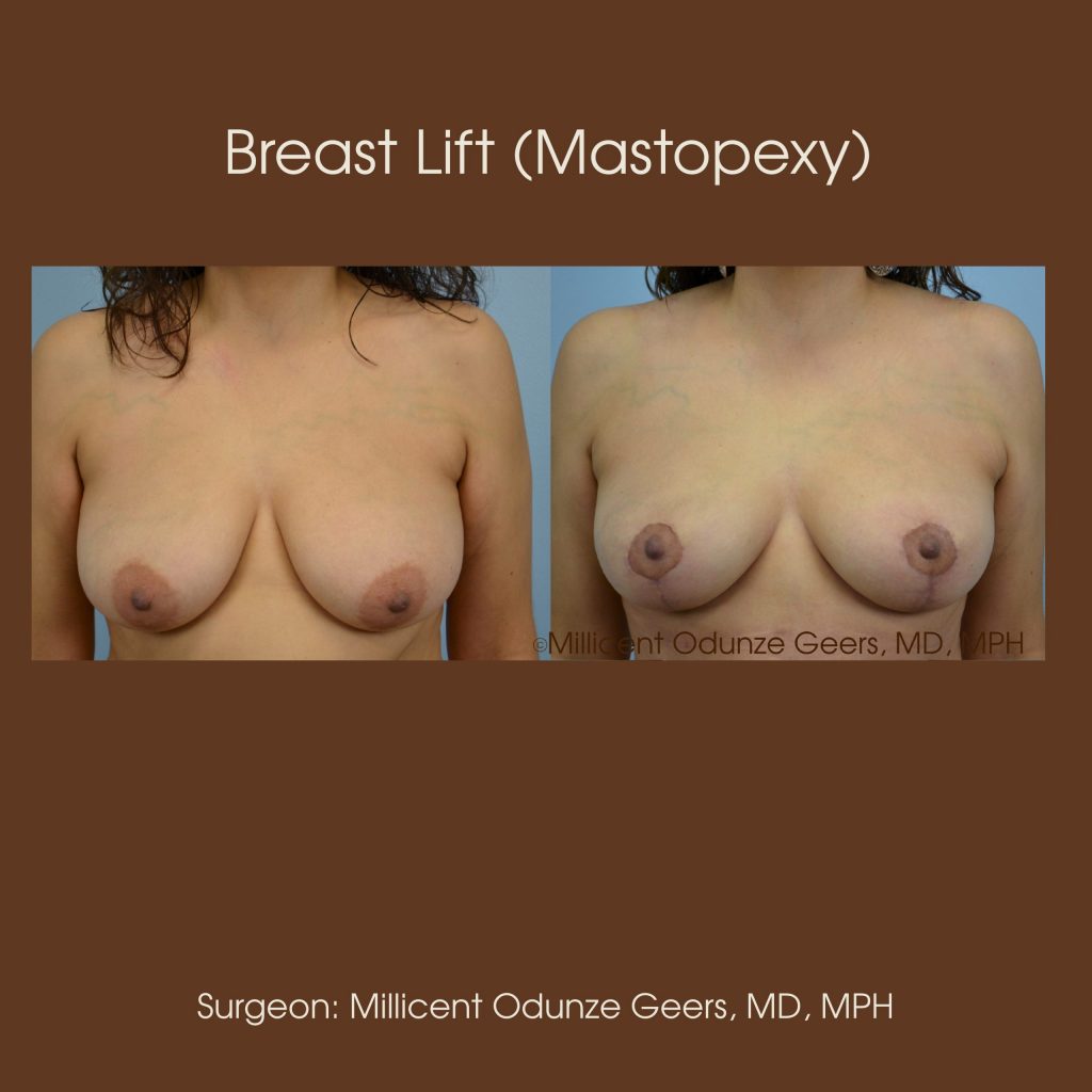 Best Breast Lift Colorado Springs