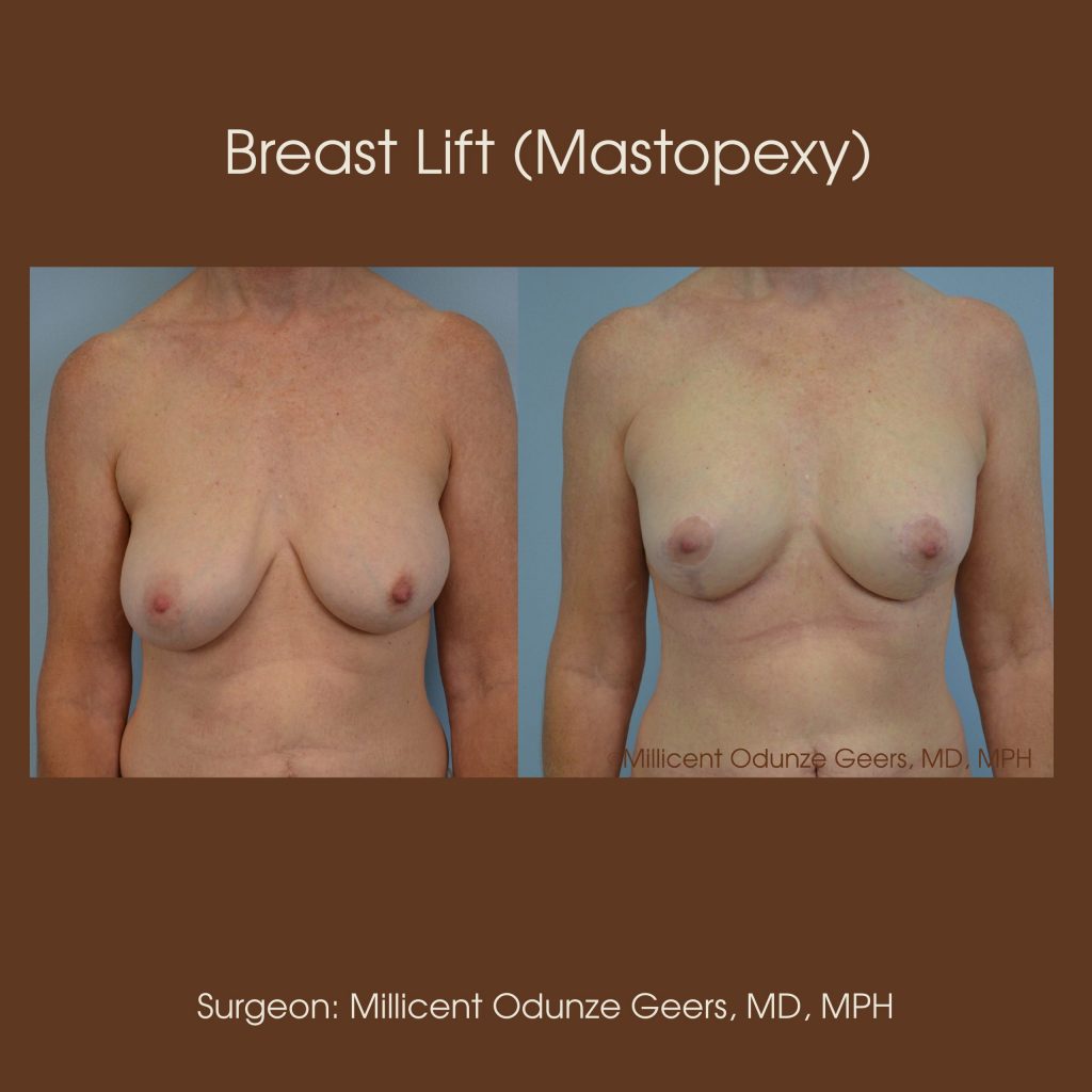 Best Breast Lift Colorado Springs