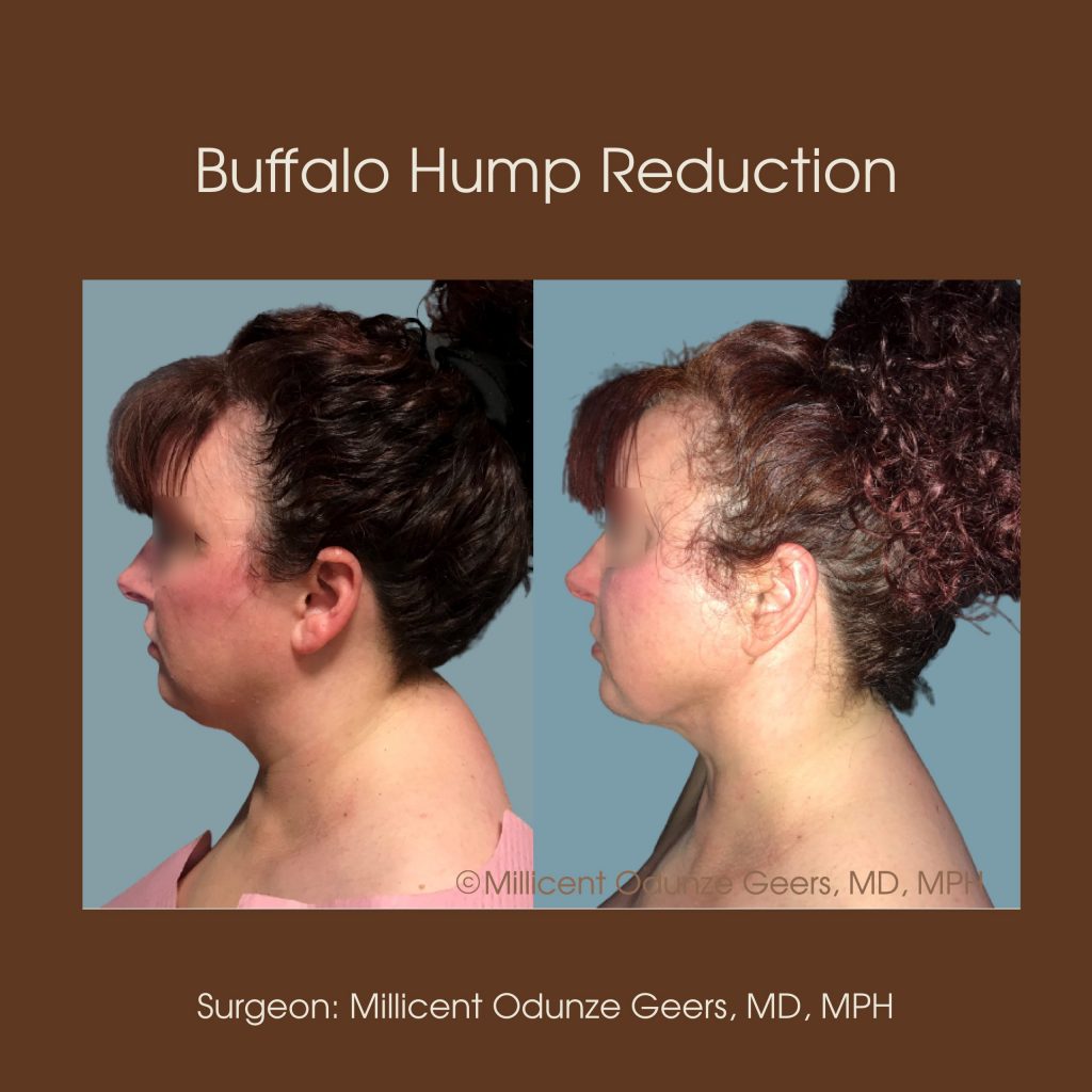 Buffalo Hump Liposuction Colorado Springs, Monument Colorado