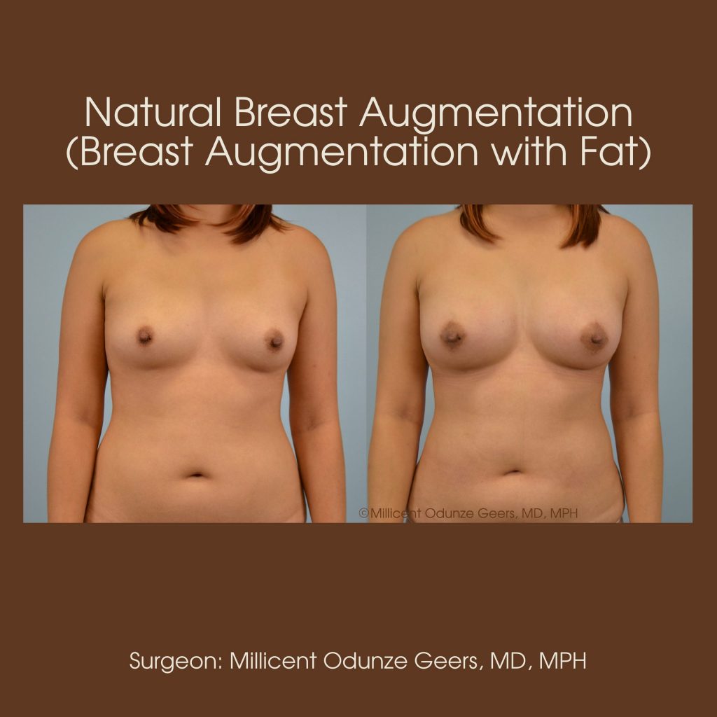 Best Colorado Springs Natural Breast Augmentation