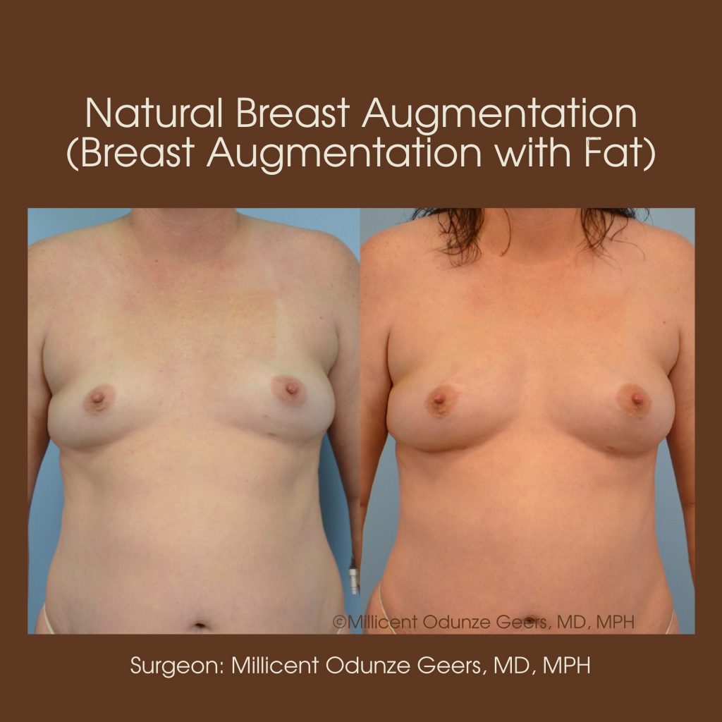 Best Colorado Springs Natural Breast Augmentation