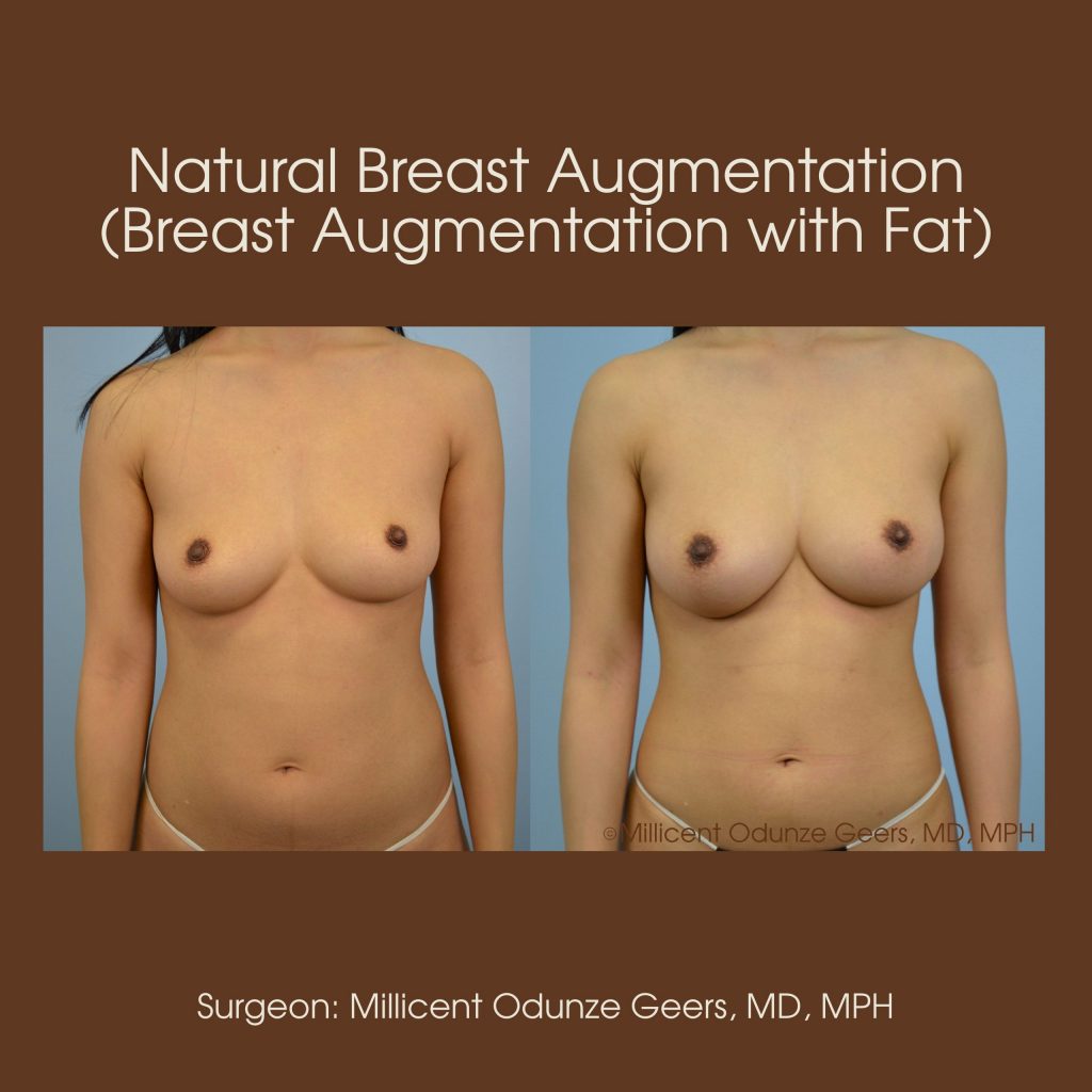 Best Colorado Springs Natural Breast Augmentation