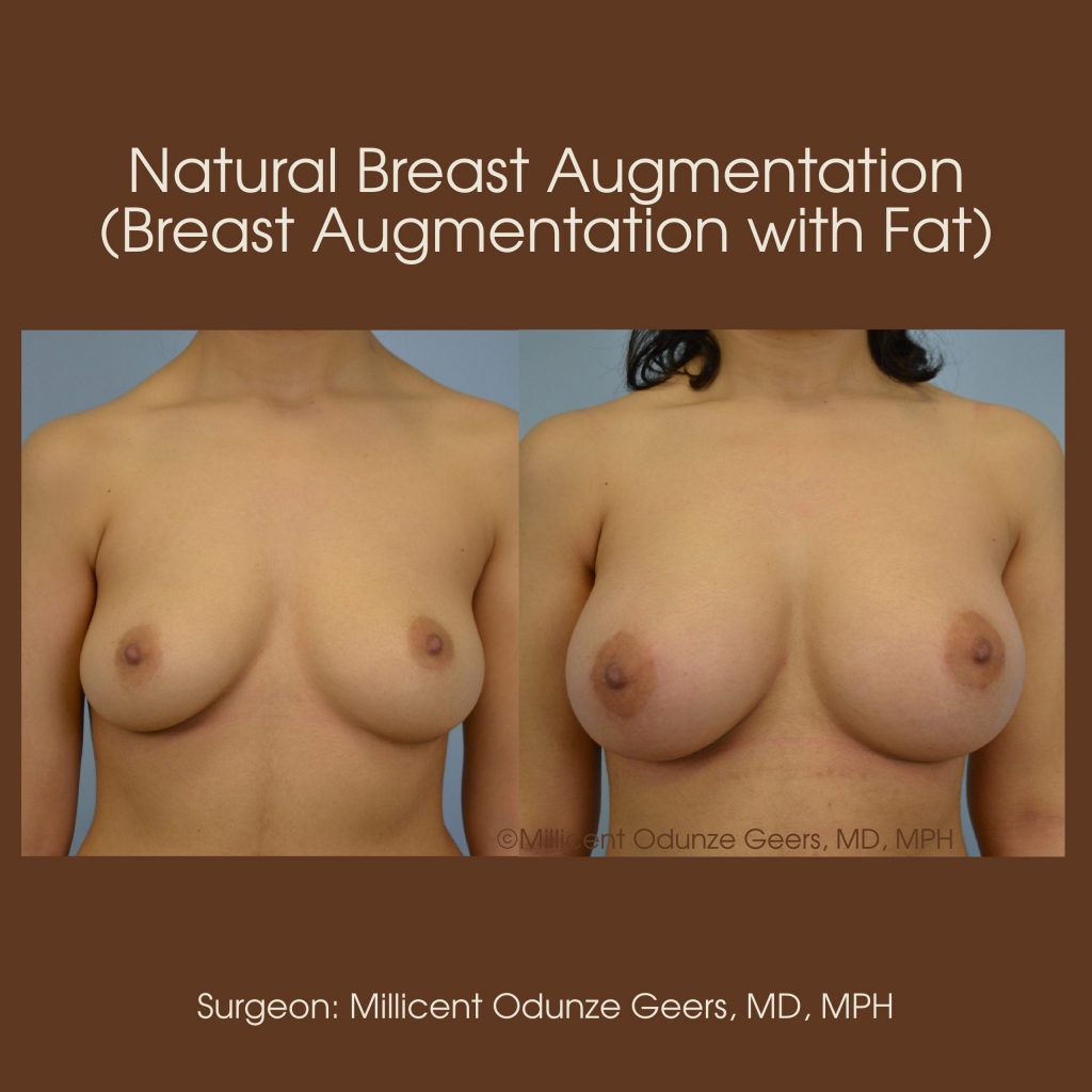 Best Colorado Springs Natural Breast Augmentation