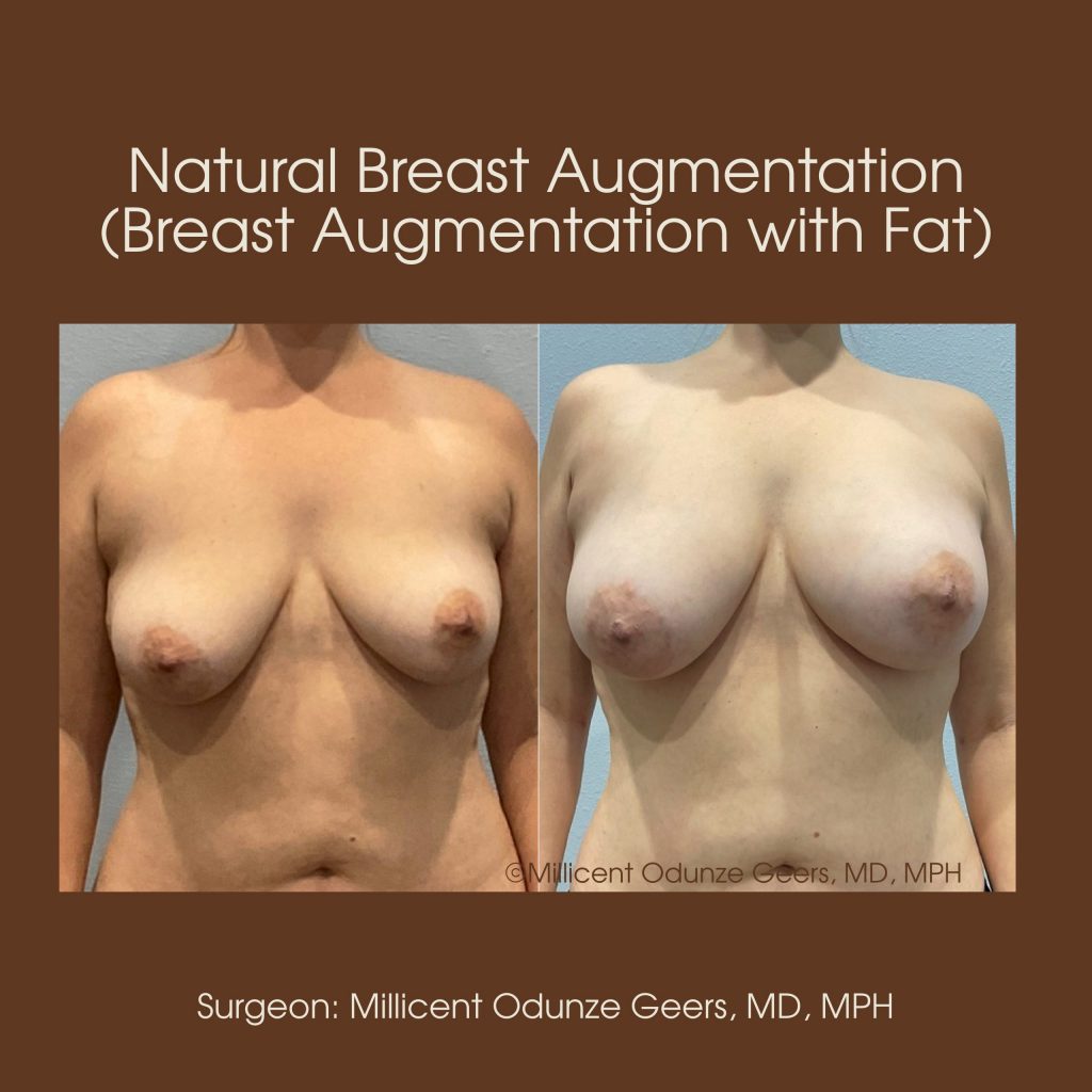 Best Colorado Springs Natural Breast Augmentation