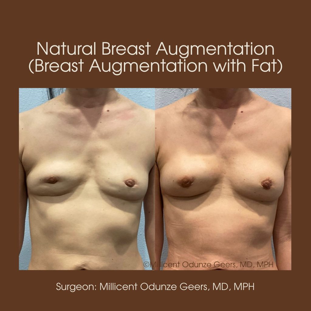 Best Colorado Springs Natural Breast Augmentation