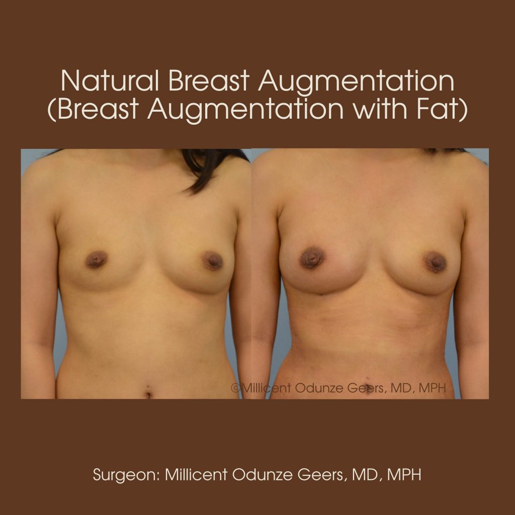 Best Colorado Springs Natural Breast Augmentation