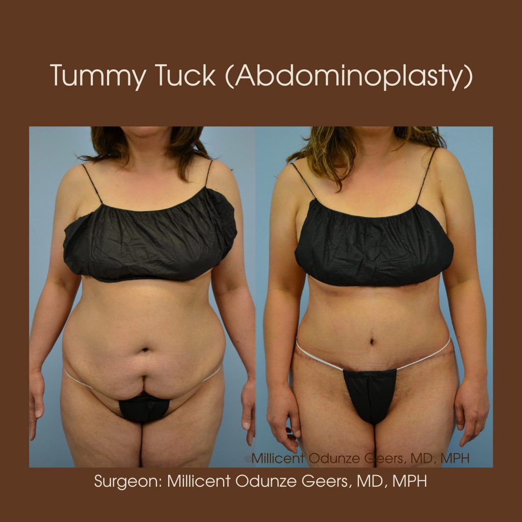 Best Tummy Tuck Colorado Springs