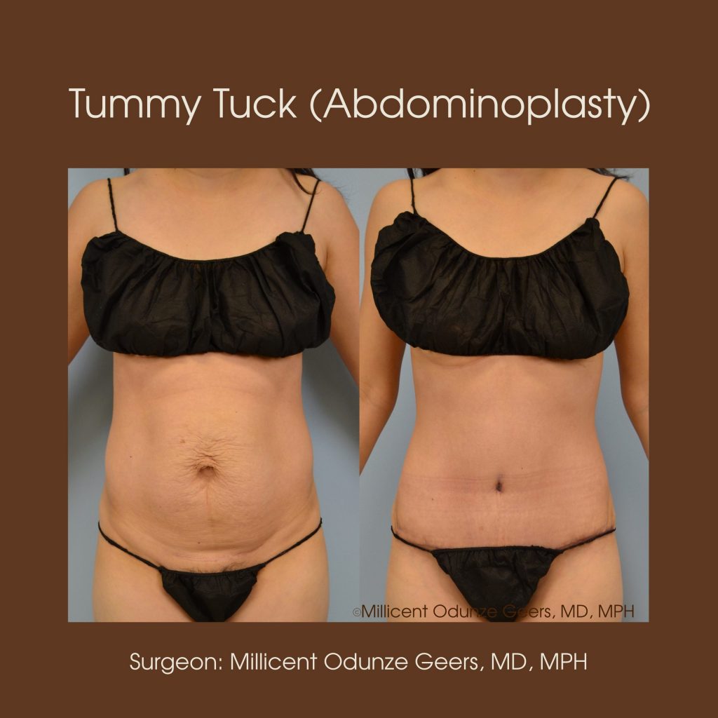 Best Tummy Tuck Colorado Springs