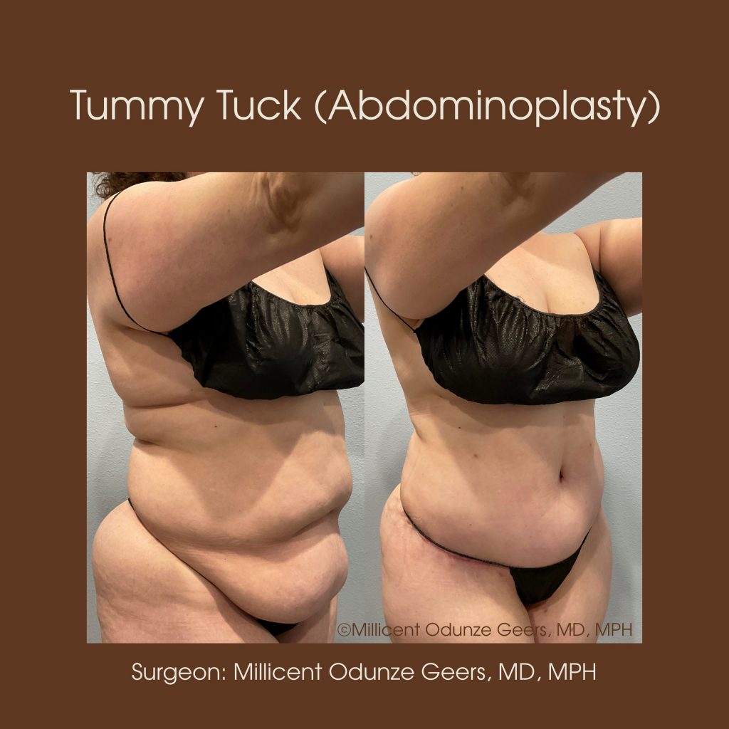 Best Tummy Tuck Colorado Springs