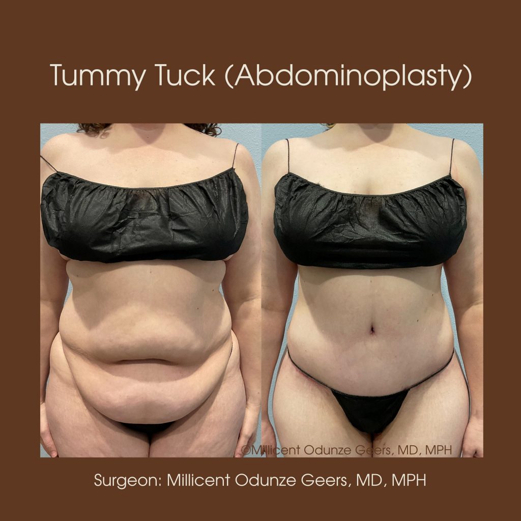 Best Tummy Tuck Colorado Springs