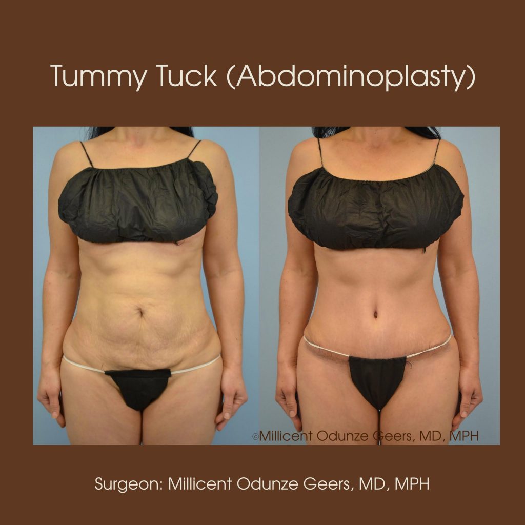 Best Tummy Tuck Colorado Springs