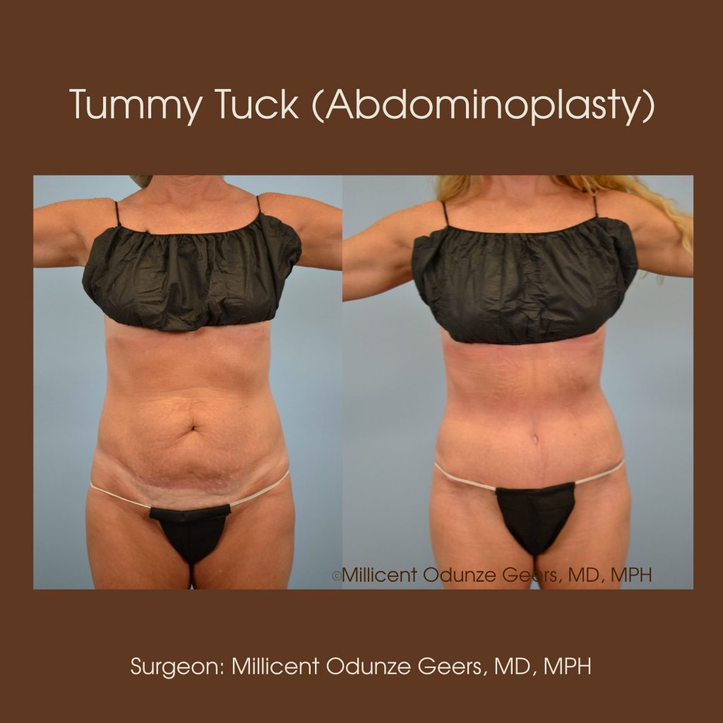 Best Tummy Tuck Colorado Springs