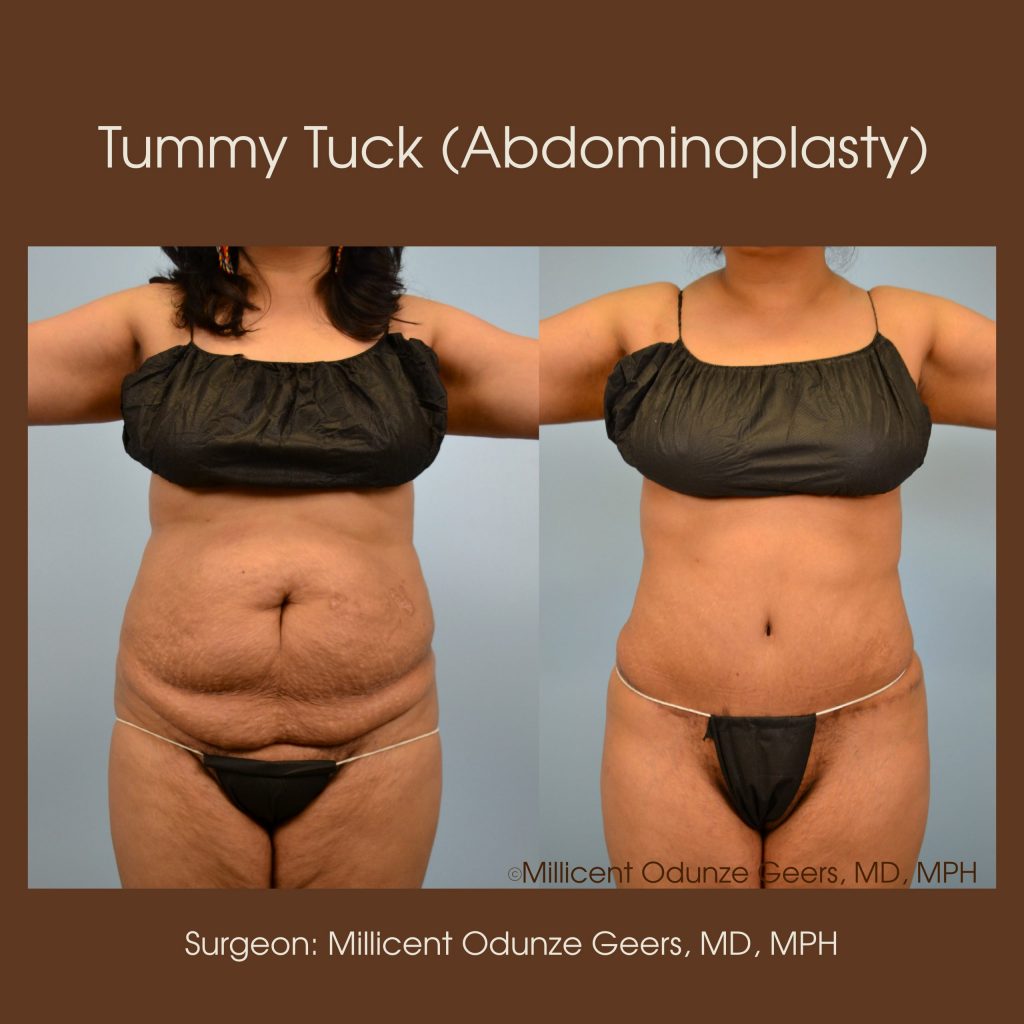 Best Tummy Tuck Colorado Springs