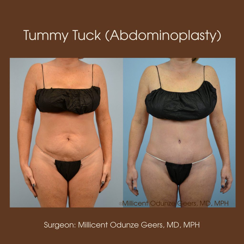 Best Tummy Tuck Colorado Springs