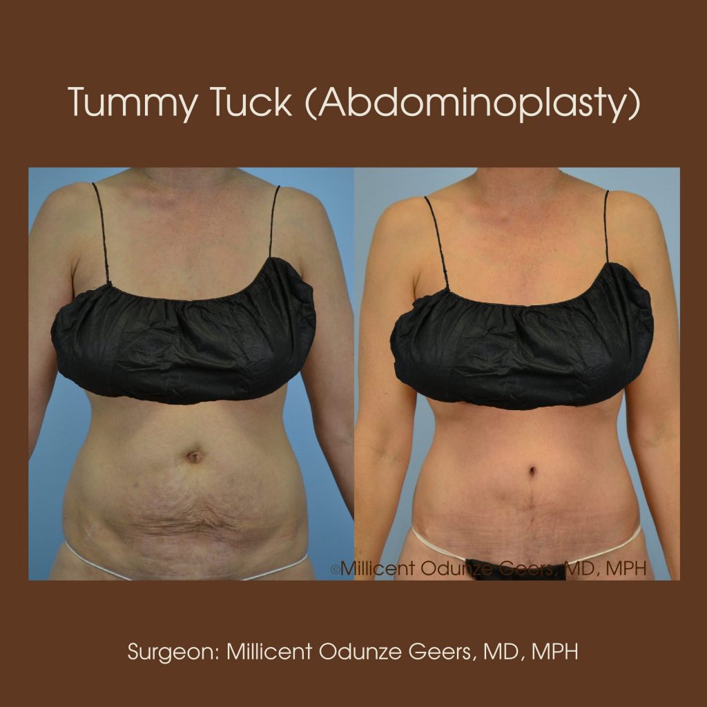 Best Tummy Tuck Colorado Springs