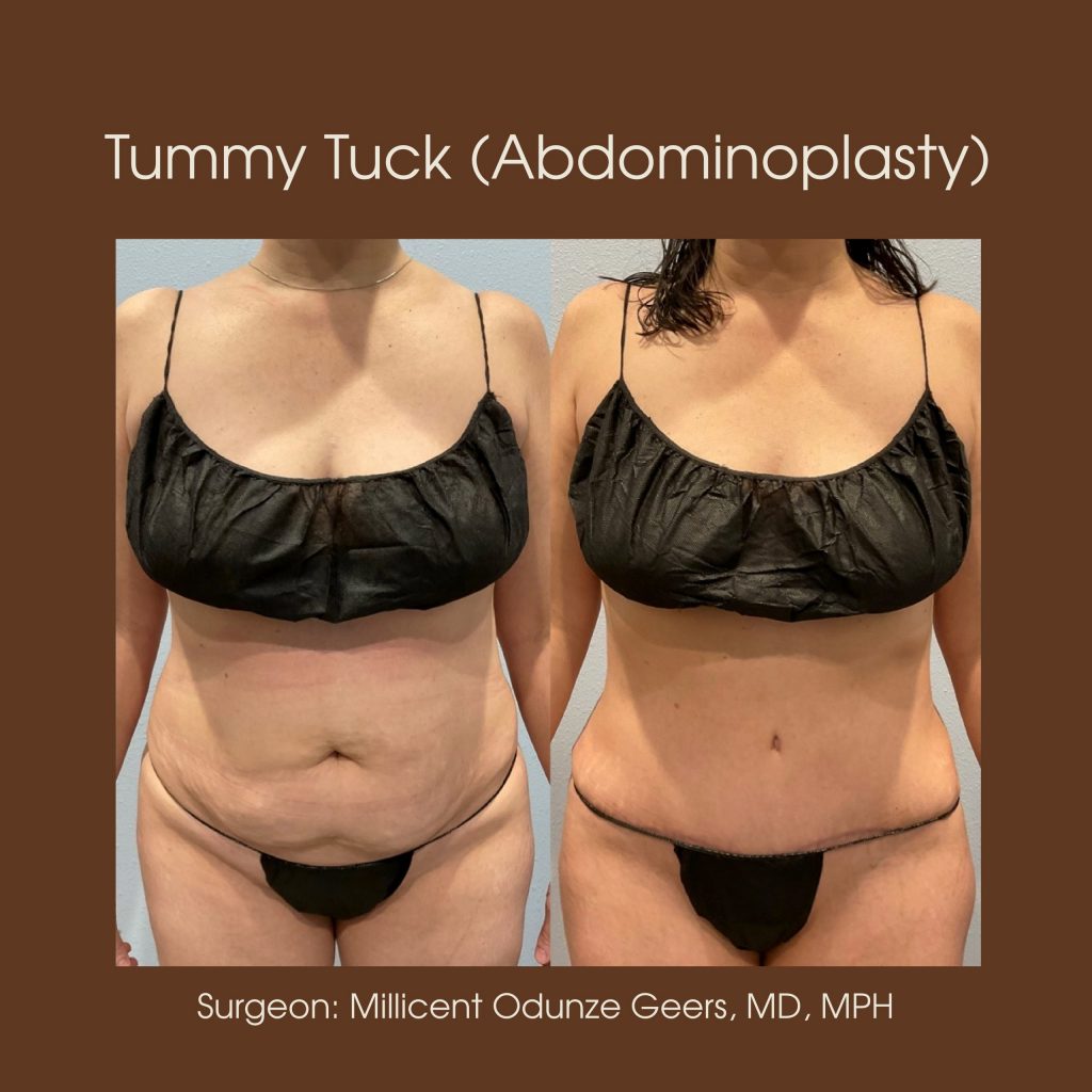 Best Awaek Tummy Tuck Colorado Springs