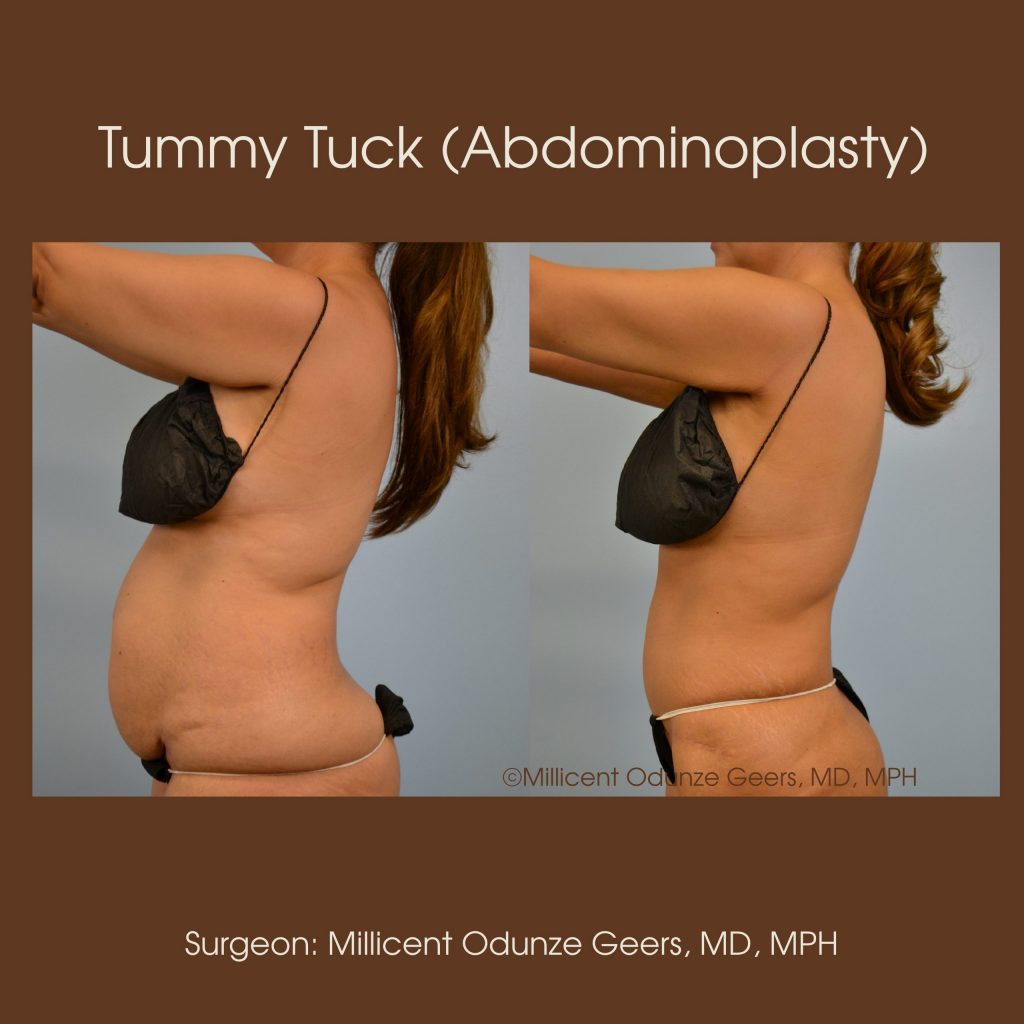 Best Tummy Tuck Colorado Springs