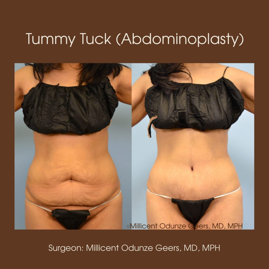 Best Tummy Tuck Colorado Springs